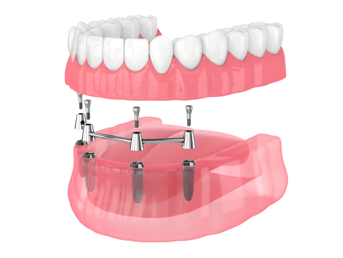 Full-Mouth Dental Implants in Denver, CO at 58 Peaks Dental